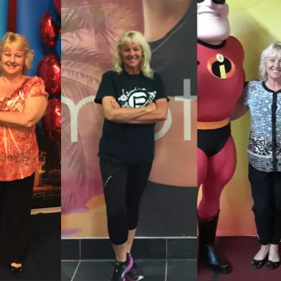 Photos of Donna Stanket before and after her bariatric procedure.