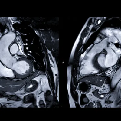 cardiac-mri-image-option1
