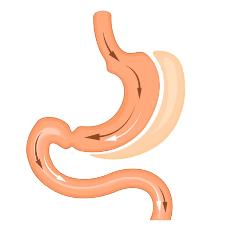 Sleeve Surgery Illustration