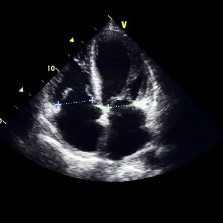 transesophageal-echocardiogram