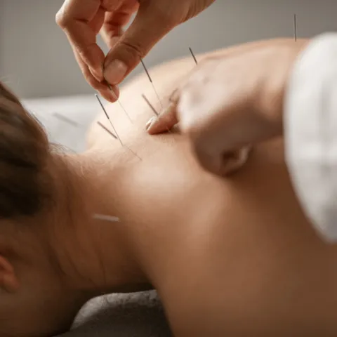 whi-blog-acupuncture-immunity-hero-2000x1333