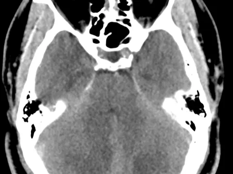 Dr. Morgan - Complex Stroke Case Study