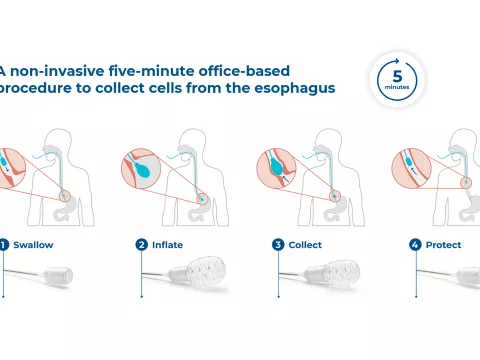 EsoGuard™ Infographic