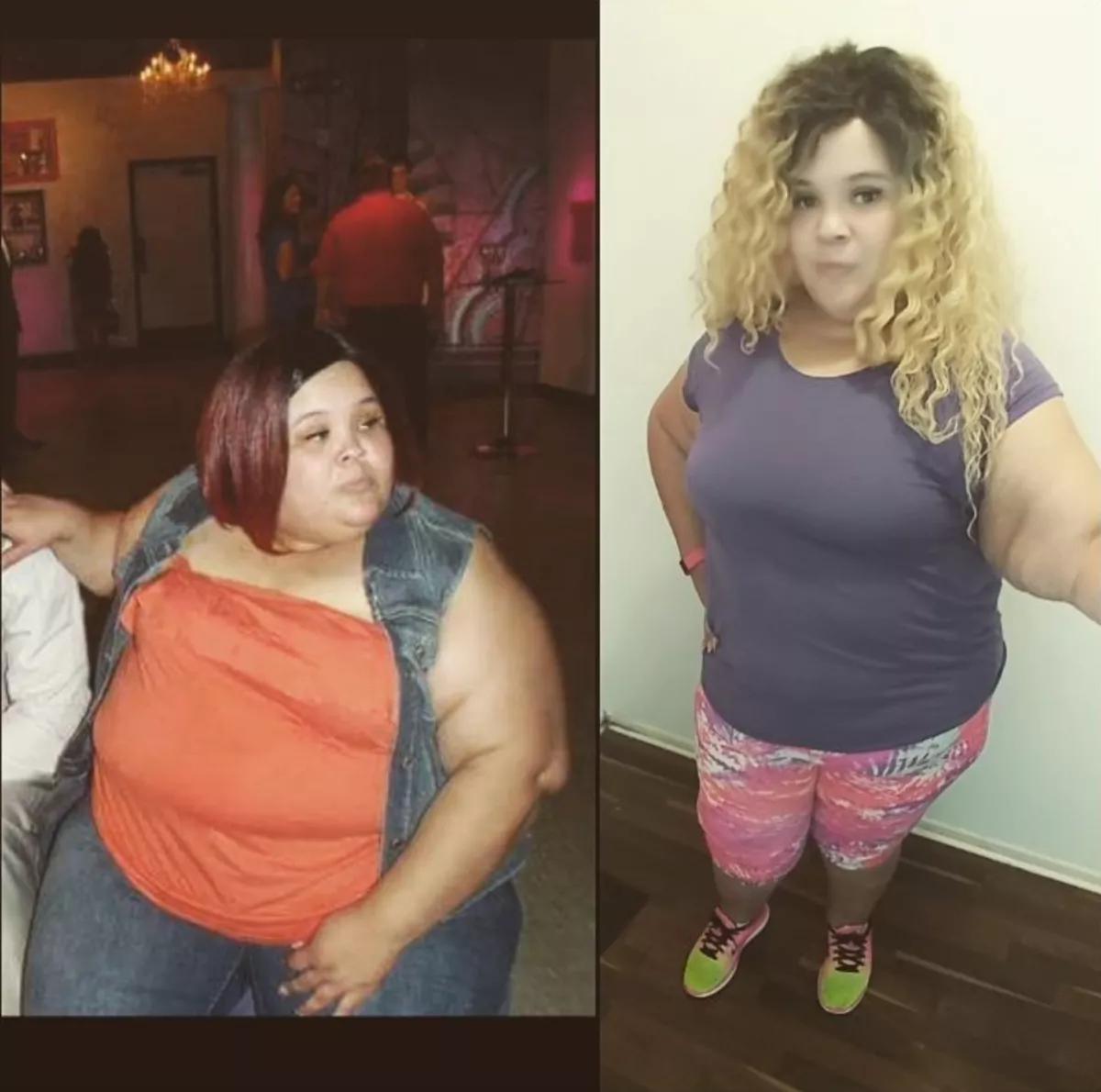 Karen Allen Before and After Bariatric Surgery.