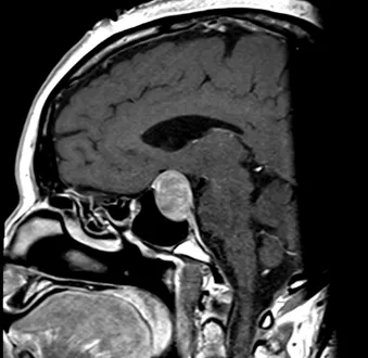 Pre Op Pituitary Tumor Image 1