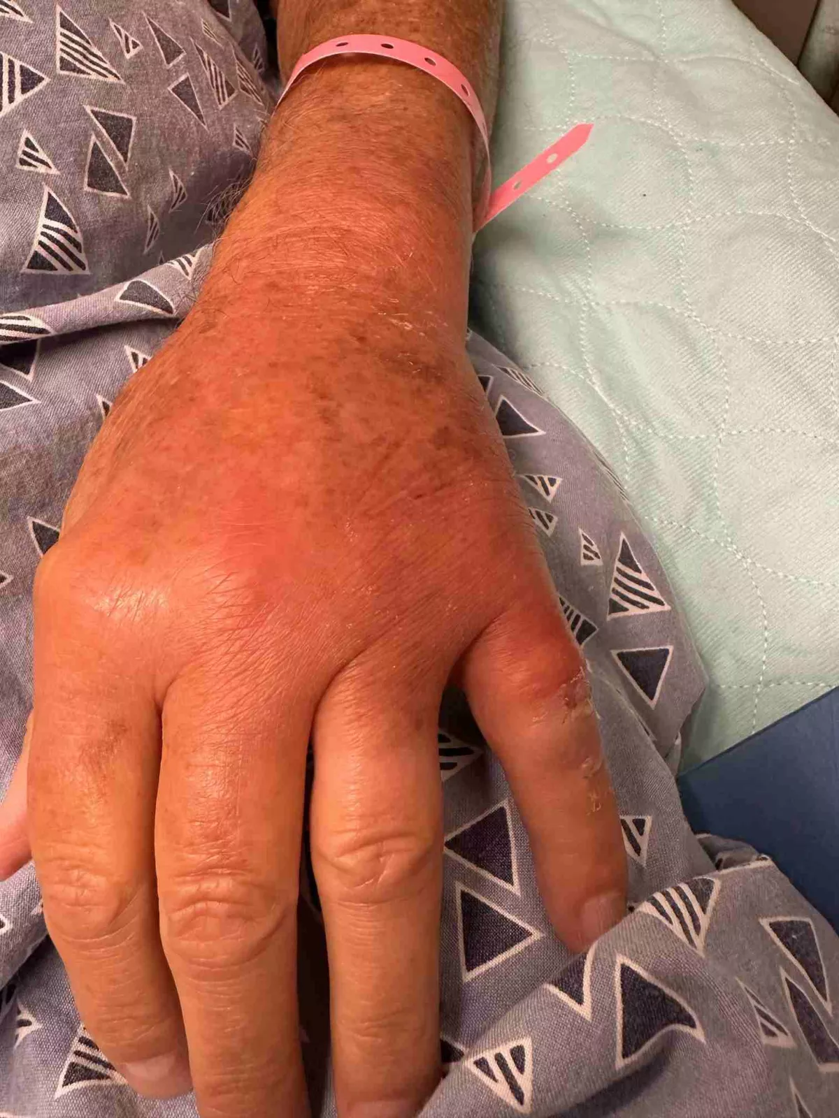 Surgeon at AdventHealth New Smyrna Beach saves patient's hand after removing large, hidden splinter that was causing serious infection