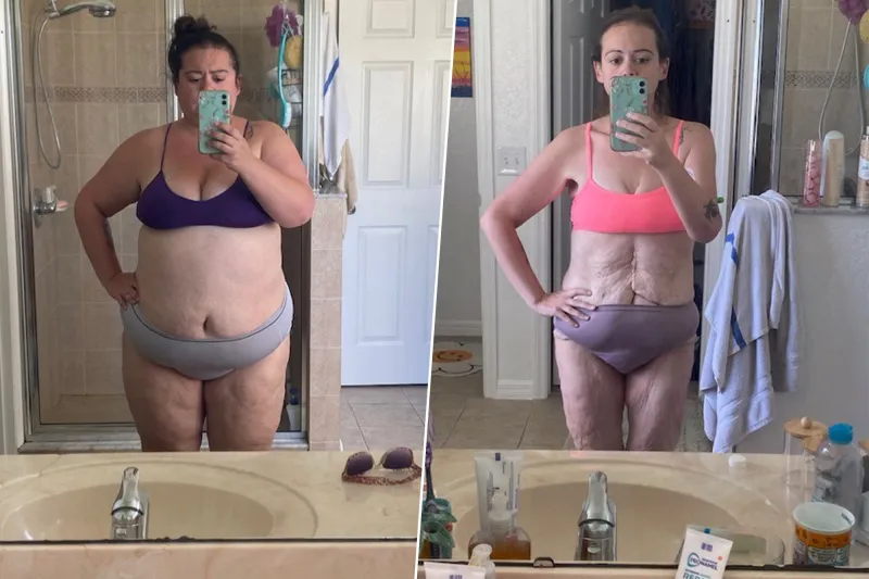 Caitlyn Before and After surgery