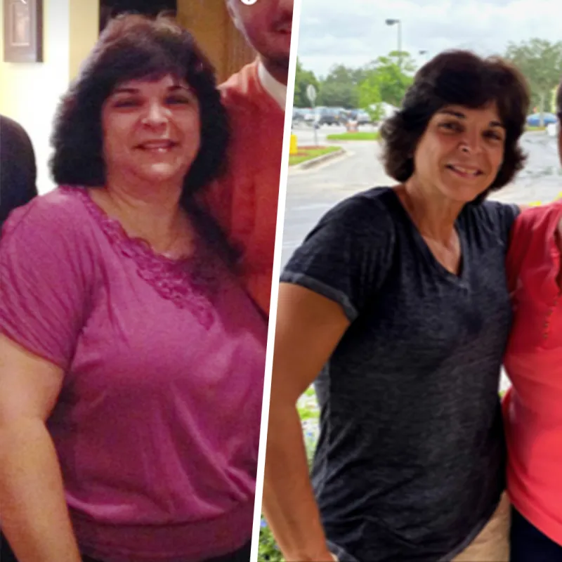 Ellen Before and After Bariatrics